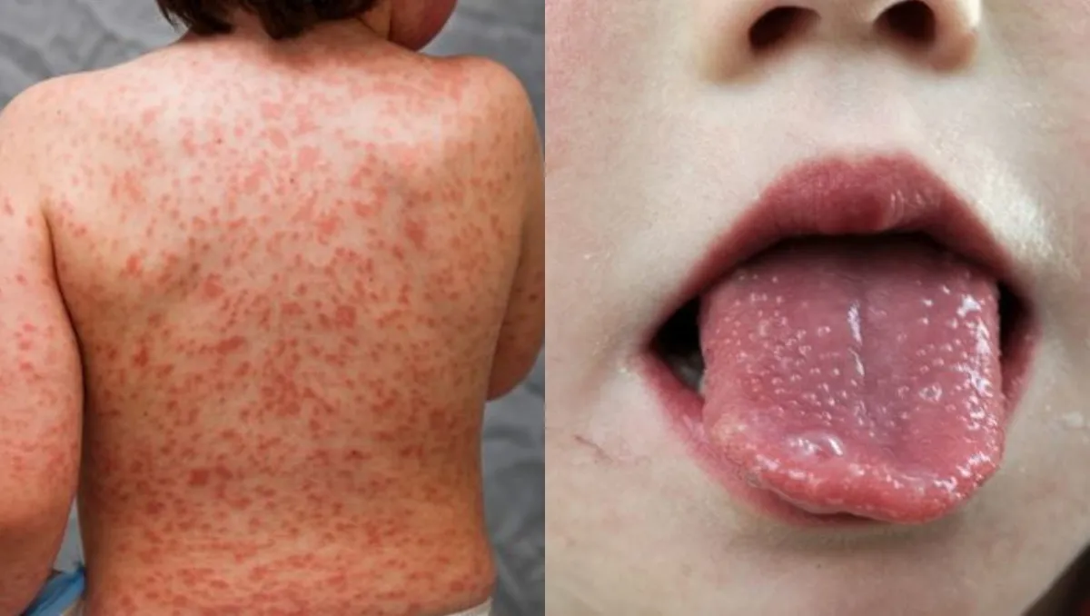 enfermedad-kawasakijpg