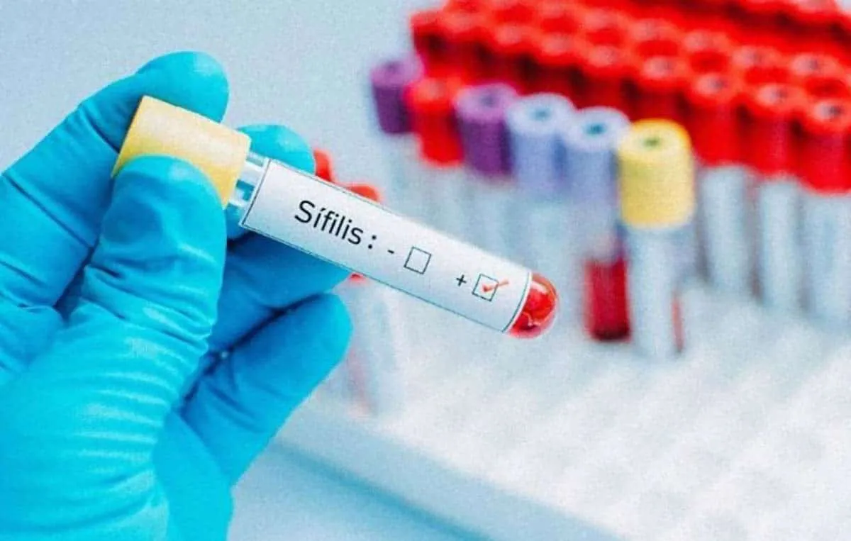 sifilis